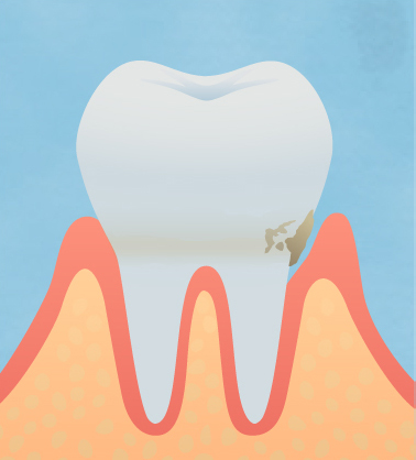 歯周病の原因は、歯垢（プラーク＝細菌の塊）です。これらを徹底的に除去しなければ歯周病は治りません。